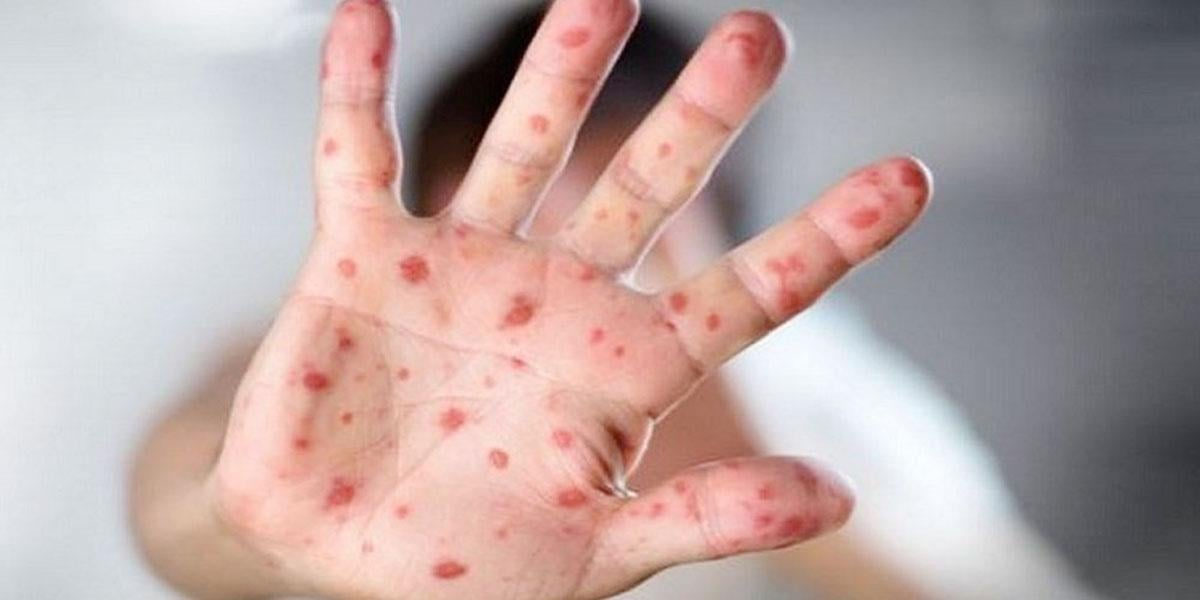 3 suspected measles deaths, 947 hospitalised in 24hrs