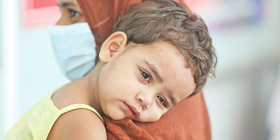 Three more children die with measles symptoms at Rajshahi Medical