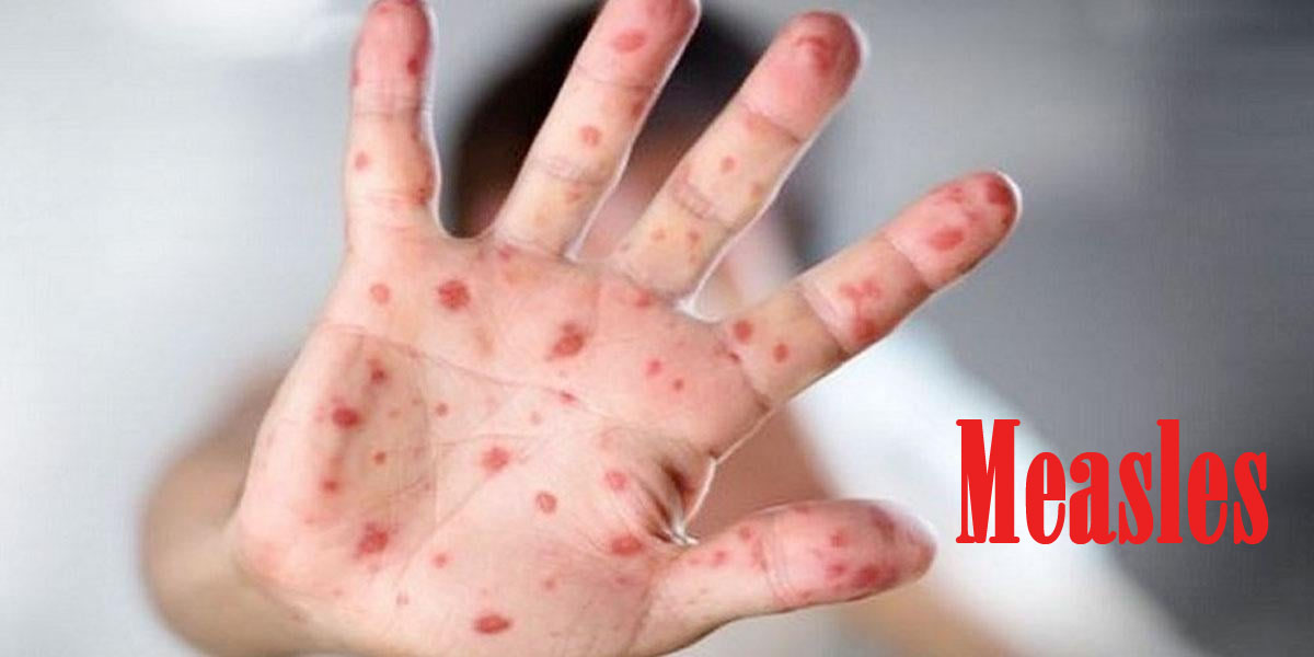 Measles death toll rises to 639 as 8 more children die in 24 hours