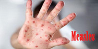 Measles death toll rises to 639 as 8 more children die in 24 hours
